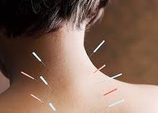 Arizona Acupuncture