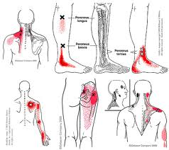 What are trigger points