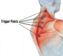 Dry Needling Mesa Gulbert Arizona