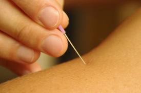 Needling Dry Needling Mesa Gilbert AZ