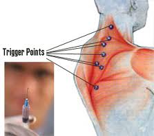 Trigger Point Injection