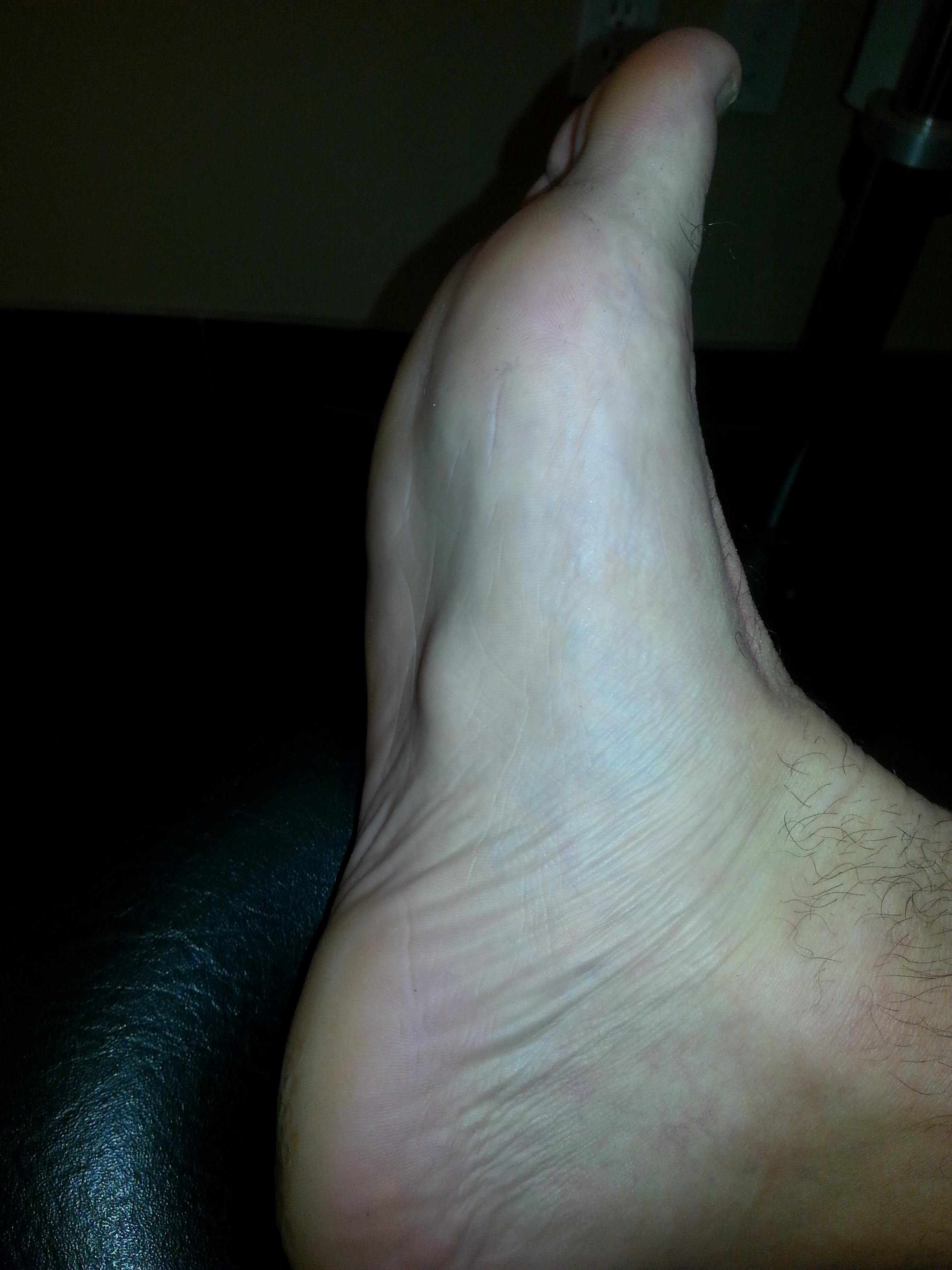 arp wave therapy for plantar fasciitis